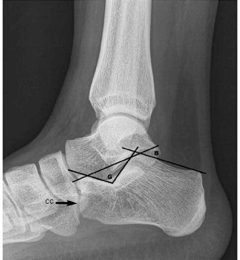 Lateral Projection Of The Calcaneus Cc Calcaneocuboïdal Joint G