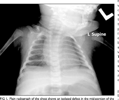 Figure 1 From Congenital Pseudarthrosis Of The Clavicle A Rare And