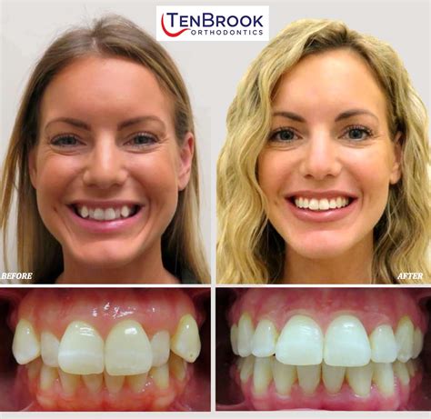 Tenbrook T1 Braces Fastest Orthodontic Treatment