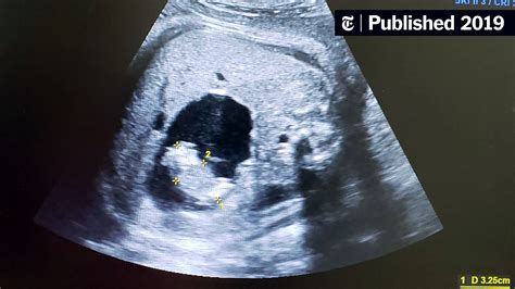 Identical Twins Ultrasound 10 Weeks