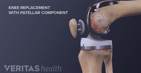 The Pros And Cons Of Minimally Invasive Knee Replacement Surgery