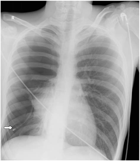 Chest Drain Pneumothorax