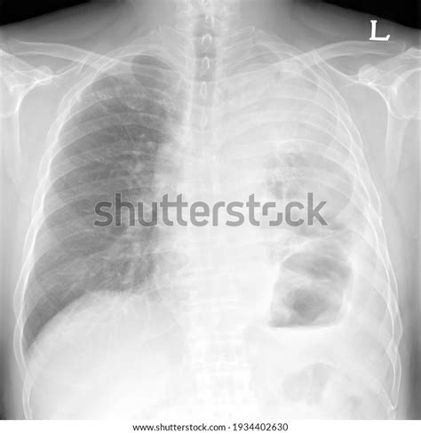 Human Chest Xray Images Abnormal Stock Photo 1934402630 Shutterstock