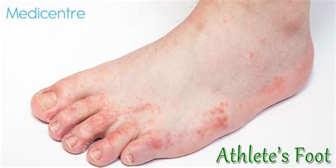 Athletes Foot Causes Symptoms And Treatments