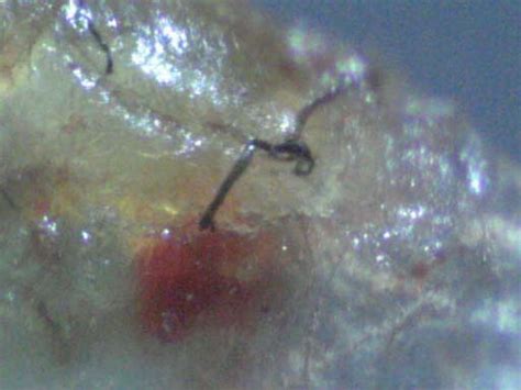 Morgellons Maryland Lyme
