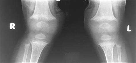 Rickets Reaction Of The Periosteum Indistinct Cortex Coarse