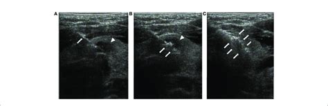 Radiofrequency Ablation Of Thyroid Isthmus Nodules Under Ultrasound