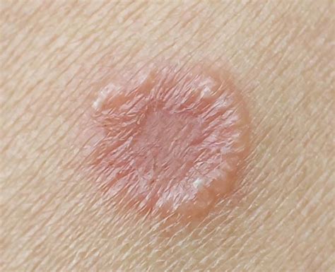 Uncovering The Causes Symptoms And Treatments For Fungal Skin