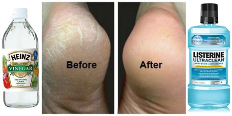 How To Fix Cracked Feet Fast