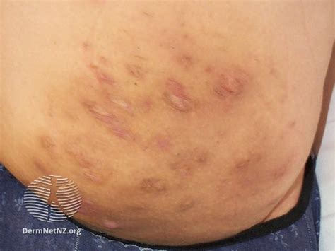 Atopic Dermatitis Symptoms Medscape Rash Symptoms Icd Codes Atopic Free Download Nude Photo