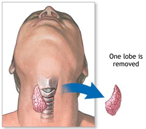 Thyroidectomy Partial Or Total Thyroidectomy Recovery And Complications