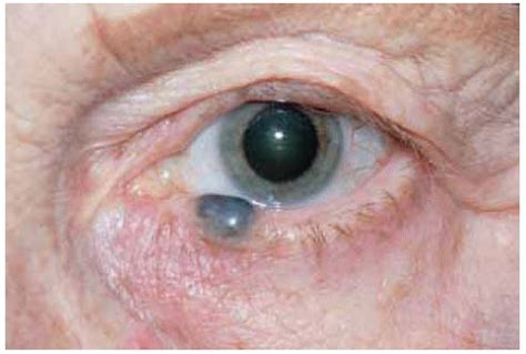 Eyelid Cystic Lesions Simulating Neoplasms Ento Key