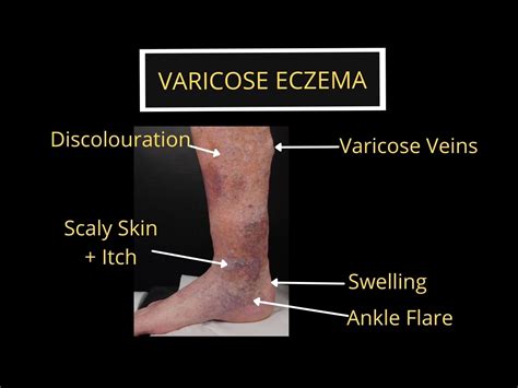 When Should I See A Doctor About My Varicose Veins The Veincare Centre