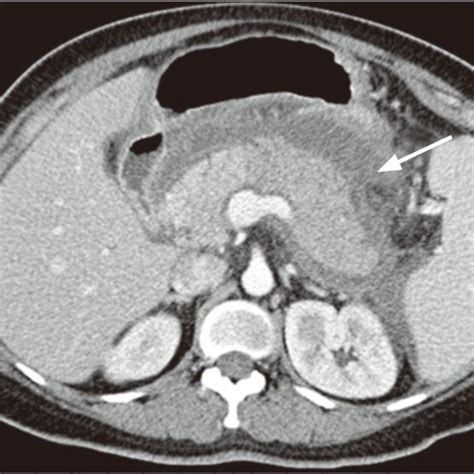 Abdominal Computed Tomography A Swelling Of The Pancreas With Adjacent