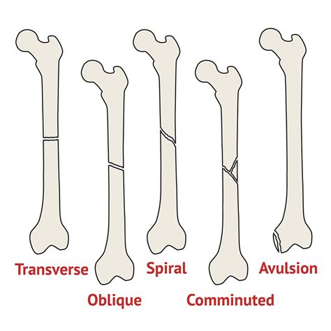 Types Of Complete Fracture Types Of Fractures Complete Fracture