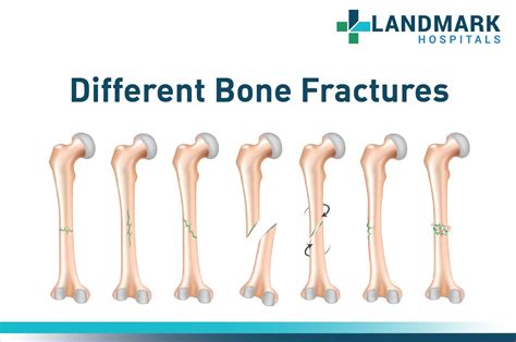Different Bone Fractures Orthopedic Care In Hyderabad Landmark Hospitals