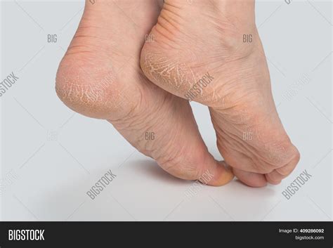 Dry Cracked Soles Feet Image And Photo Free Trial Bigstock