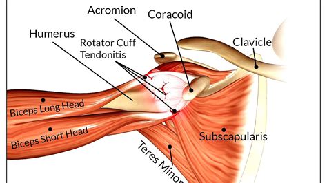 Symptoms Rotator Cuff Injury Injury Choices
