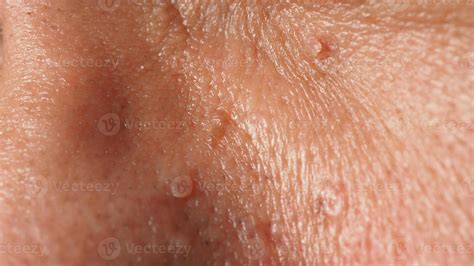 Wart On Face Macro Shot Of Wart Near Eye Papilloma On Skin 5042495