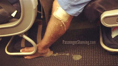 Airplane Passenger With Horrific Pus Oozing Leg Wound Is What Travel