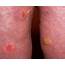 Derm Dx Skin Blisters And Erosion In An Elderly Woman  Dermatology