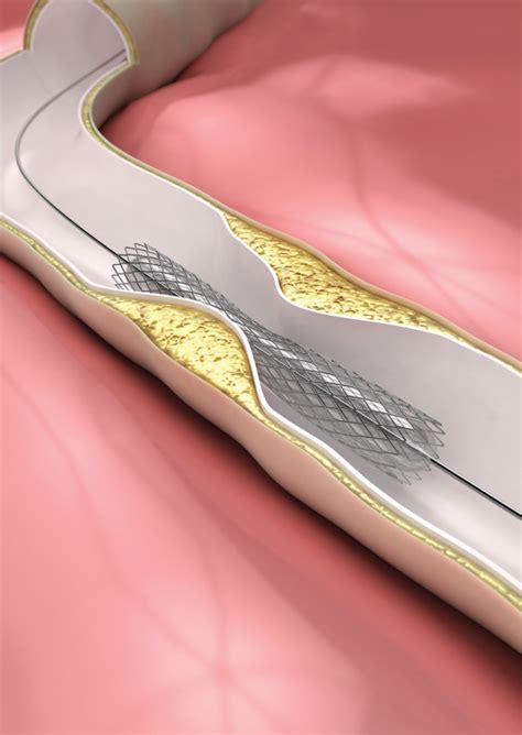 Stent Placement Improves Avf Patency After Stenosis Renal And Urology