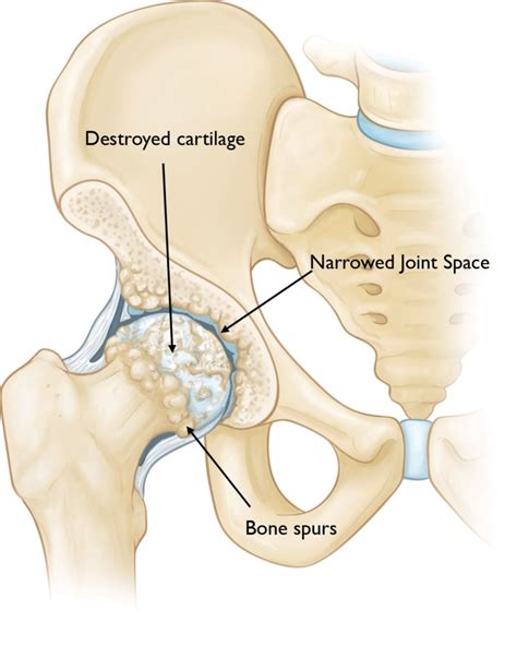 Osteoarthritis Of The Hip Orthopedic Sports Medicine