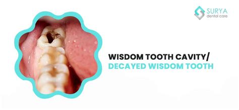 Wisdom Tooth Cavity Decayed Wisdom Tooth
