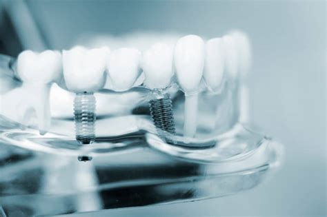 How Long Do Dental Implants And Mini Dental Implants Last