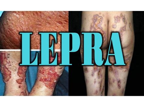 La lepra es una enfermedad infecciosa crónica que afecta únicamente a la especie humana y se caracteriza por la aparición de lesiones en la piel, los nervios y las mucosas. LEPRA - ENFERMEDAD DE HANSEN - ULCERAS CUTÁNEAS, DAÑO ...