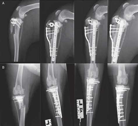Pdf Treatment Of Tibial Diaphyseal Fractures Following Plateless