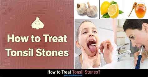 Top 7 Tonsil Stones Prevention Guide 2022