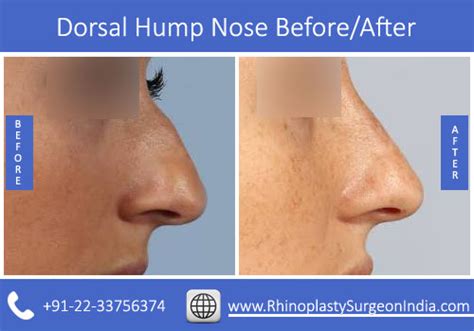 Dorsal Hump Nose Treatment In Mumbai India Rhinoplasty Surgeon India