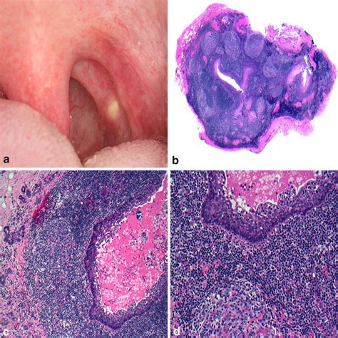 Oral Lymphoepithelial Cyst A Slightly Raised Yellow Nodule Arising In