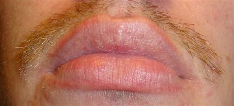 Pictures Of White Fordyce Spots On Lips