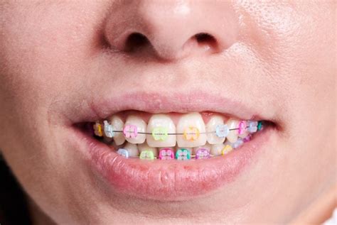 Coloured Braces How They Work And How To Choose Your Colours