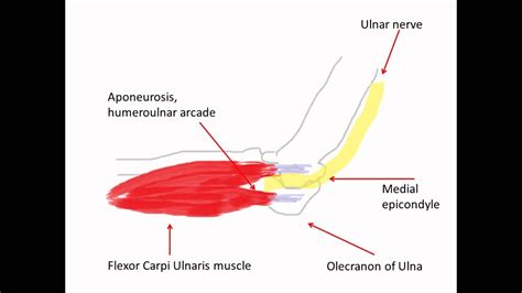 Sonographic Detection Of Ulnar Nerve Compression During Elbow Extension