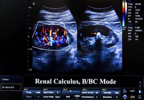 122 Renal Ultrasound Stock Photos Free And Royalty Free Stock Photos