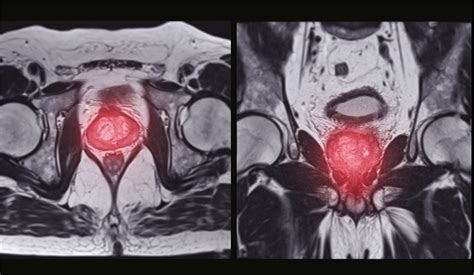Mri Is More Accurate Than A Psma Pet Ct Scan For Prostate Cancer Diagnosis Cancer