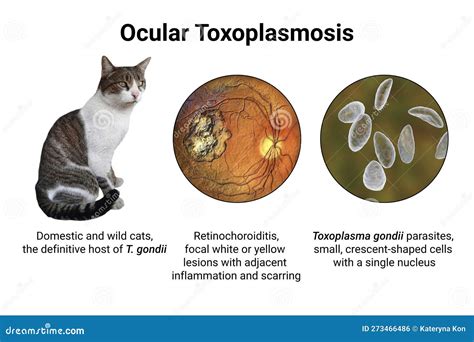 Ocular Toxoplasmosis Retinal Scar Caused By A Toxoplasma Gondii