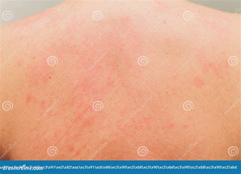 Allergic Rash On The Body Of The Patient Stock Image Image Of