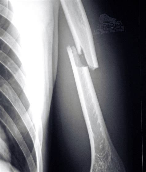 Fractured Humerus Recovery Time Is About 9 To 16 Weeks Depending On Severity Arm Upperarm