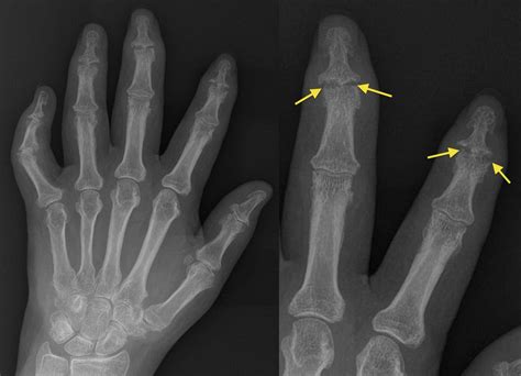 Hand X Ray Anatomy