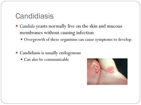 Ppt Fungal Infections Powerpoint Presentation Free Download Id2014488
