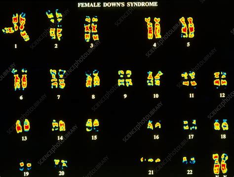 Coloured Lm Of Karyotype Of Downs Syndrome Female Stock Image M3520009 Science Photo Library