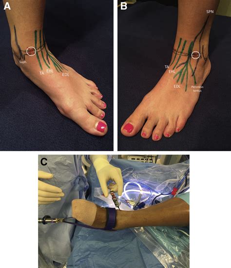 A With The Patient Supine The Medial Malleolus And Tibialis Anterior