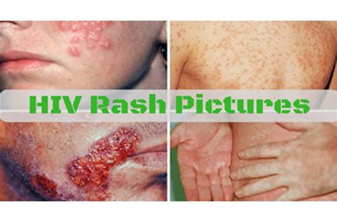 Hiv Rash Secondary Syphilis With Atypical Rash And Hemoptysis In A