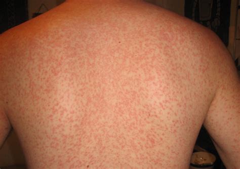 Pictures Of A Rash From Strep Throat Picturemeta