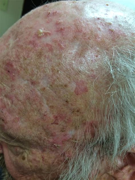 What Is Meant By Pre Skin Cancer Actinic Keratosis