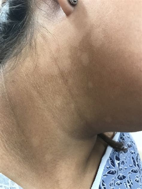 Dermatitis manchas blancas en la piel por estrés PorEstrés com